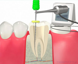 ルートZXについて | 秋津の歯医者・徹底した痛みへの配慮｜秋津歯科