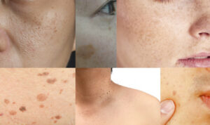 しみ・そばかす | 立川皮膚科クリニック｜ニキビ、シミ、赤ら顔の治療