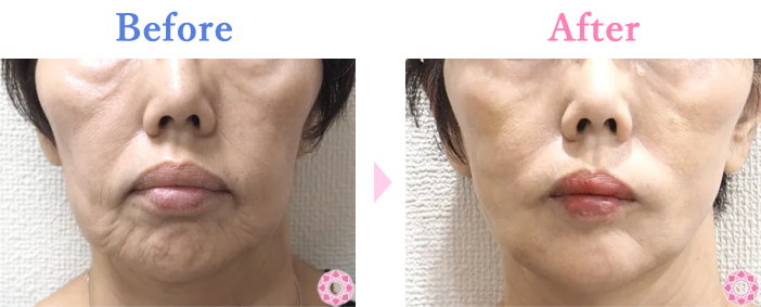 シワ取り（ボトックス）｜ボトックス｜美容整形のことなら東京形成美容