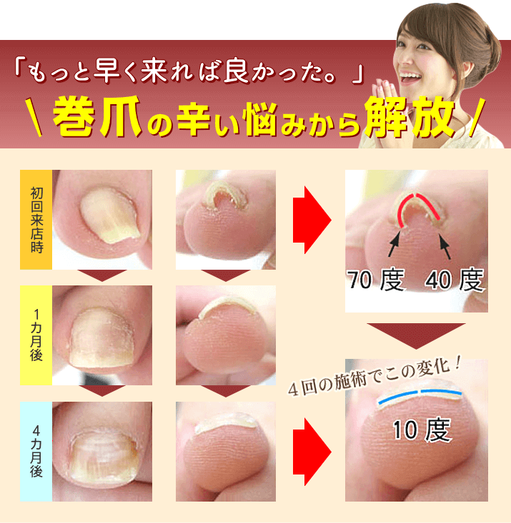 巻爪ケア｜あかり整足所