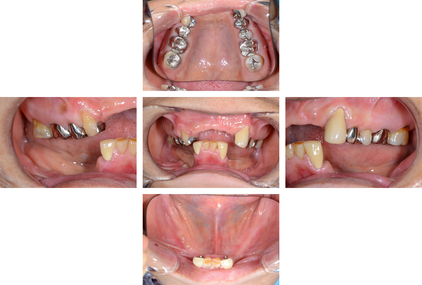 CASE10 義歯（入れ歯）症例 | 秋津の歯医者・徹底した痛みへの配慮