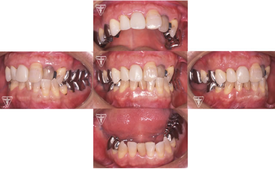 40代男性：10年後も維持！顎のずれ、歯並びを治してストレスフリーの