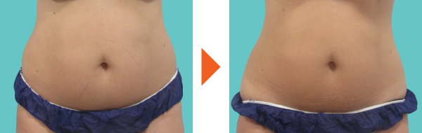 クールテック（脂肪冷却ダイエット）｜大阪 恵聖会クリニック（美容