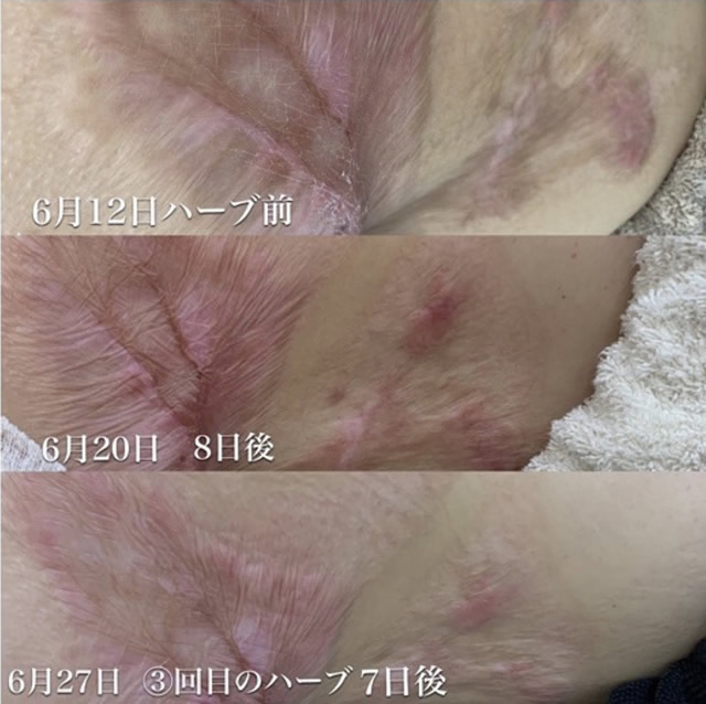 HERMOSA｜PURSUE エルモサハーブトリートメント