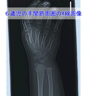 子どもの手首の骨折・前腕遠位端骨端線離開