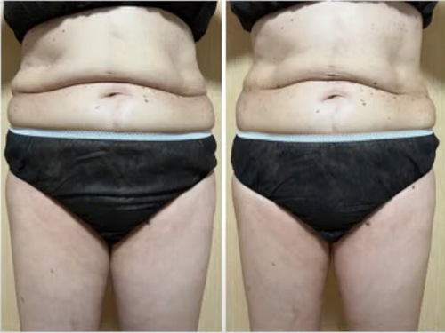 マッコイ | ノンFシェイプEX G 詰め替え用