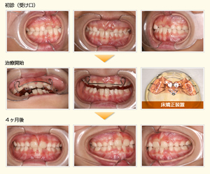 子供の矯正について | にしお歯科