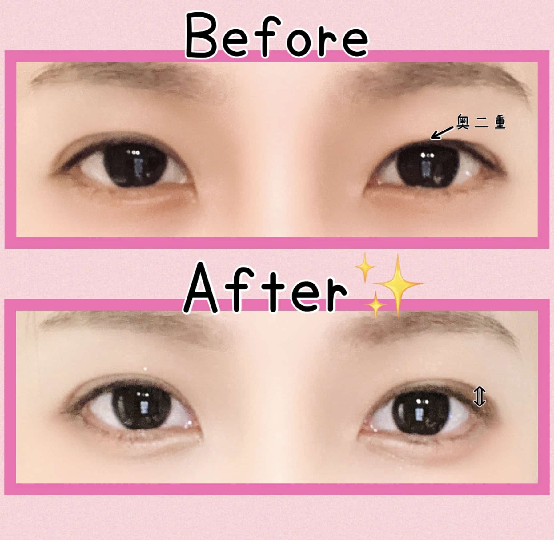 実証】ABメジカルファイバーは本当に強力なのか!?使用方法も解説