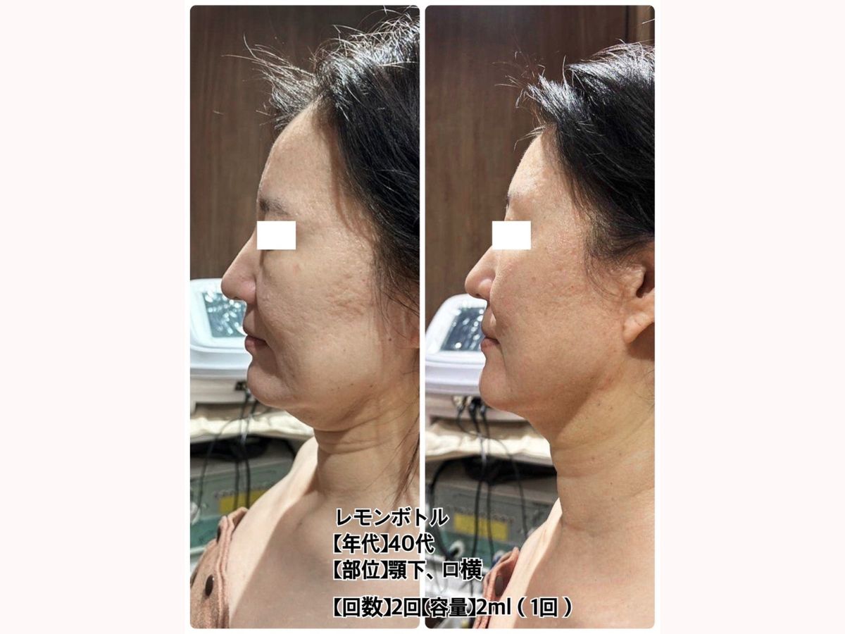 レモンボトル - エステティックサロンSARA | 山口県宇部市