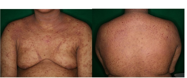 アトピー性皮膚炎・水前寺皮フ科医院｜熊本市の皮膚科・形成外科