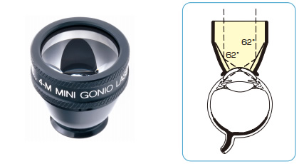 フォーミラーミニゴニオレーザーレンズ NMR型 | アールイーメディカル