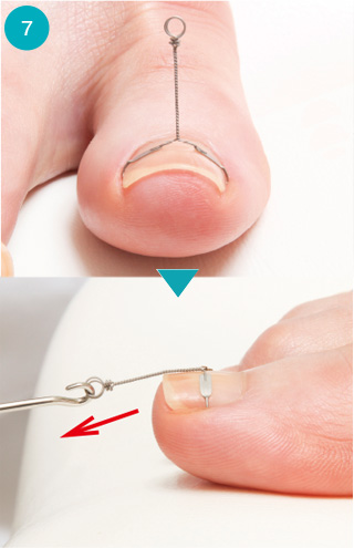 巻き爪矯正器具【コレクティオパーフェクト】医療機関の方へ | 株式