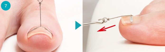 巻き爪矯正器具【コレクティオパーフェクト】医療機関の方へ | 株式