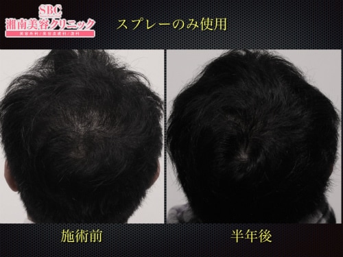 症例写真】オリジナルスプレー 外用のみでも効果あります！｜湘南AGA