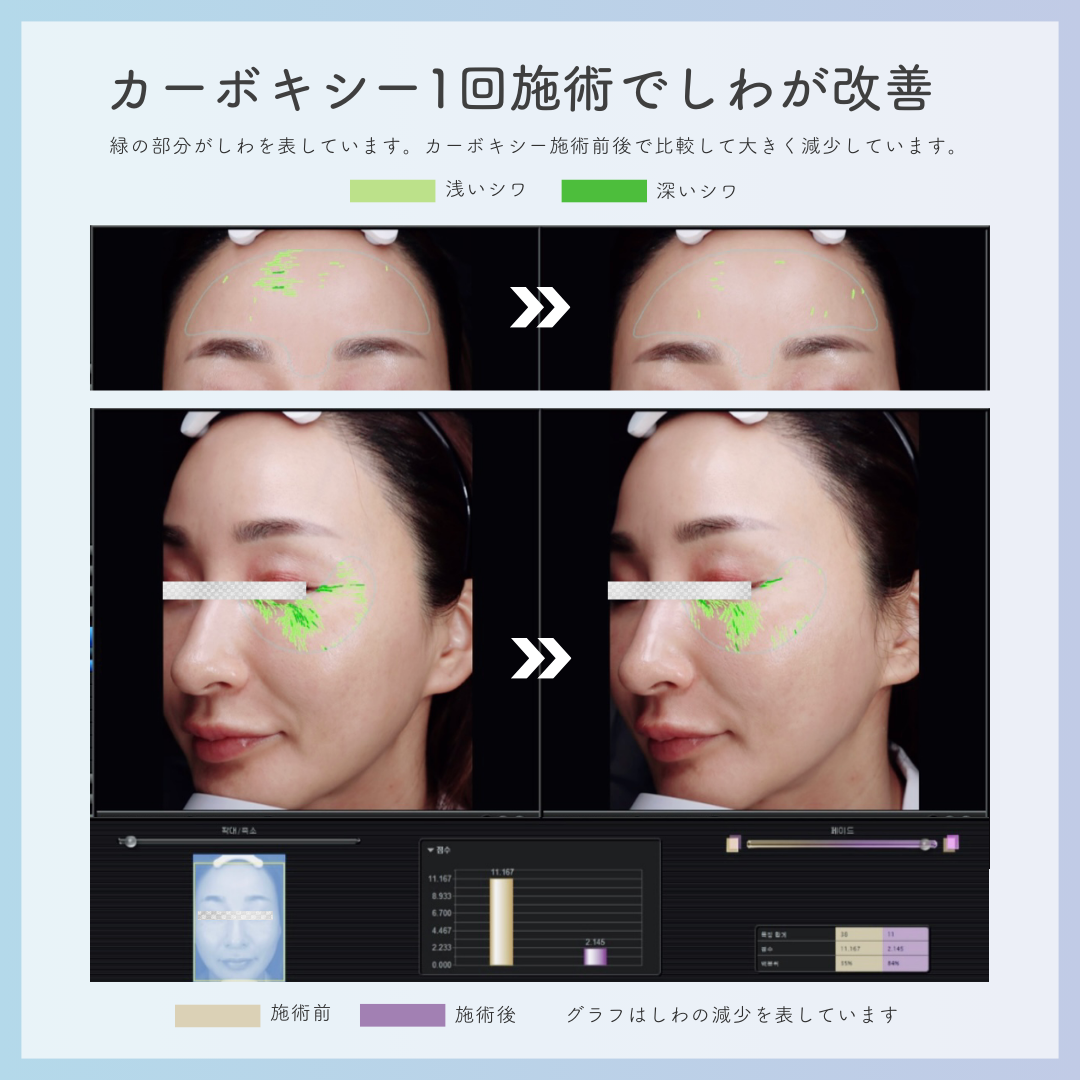 RIBESKIN】カーボキシー炭酸パック（5回分）