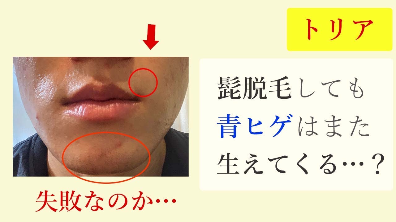 トリアで髭脱毛してもまた生えてくる・・・？#髭脱毛11回目 - YouTube