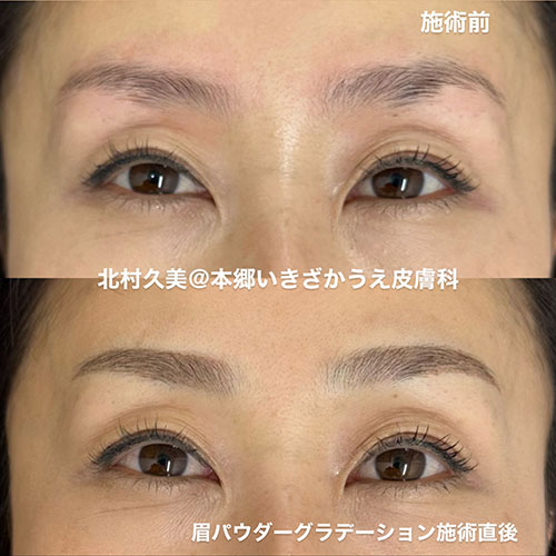 アートメイク｜本郷いきざかうえ皮膚科｜文京区