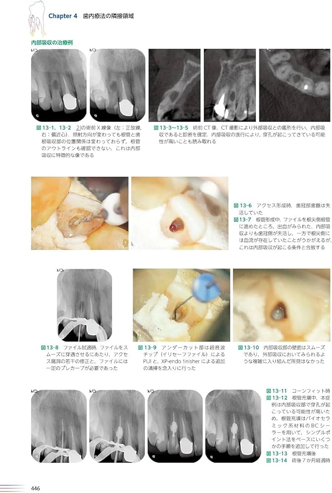 世界基準の臨床歯内療法 第2版 | 石井 宏, 石井 宏 |本 | 通販 | Amazon