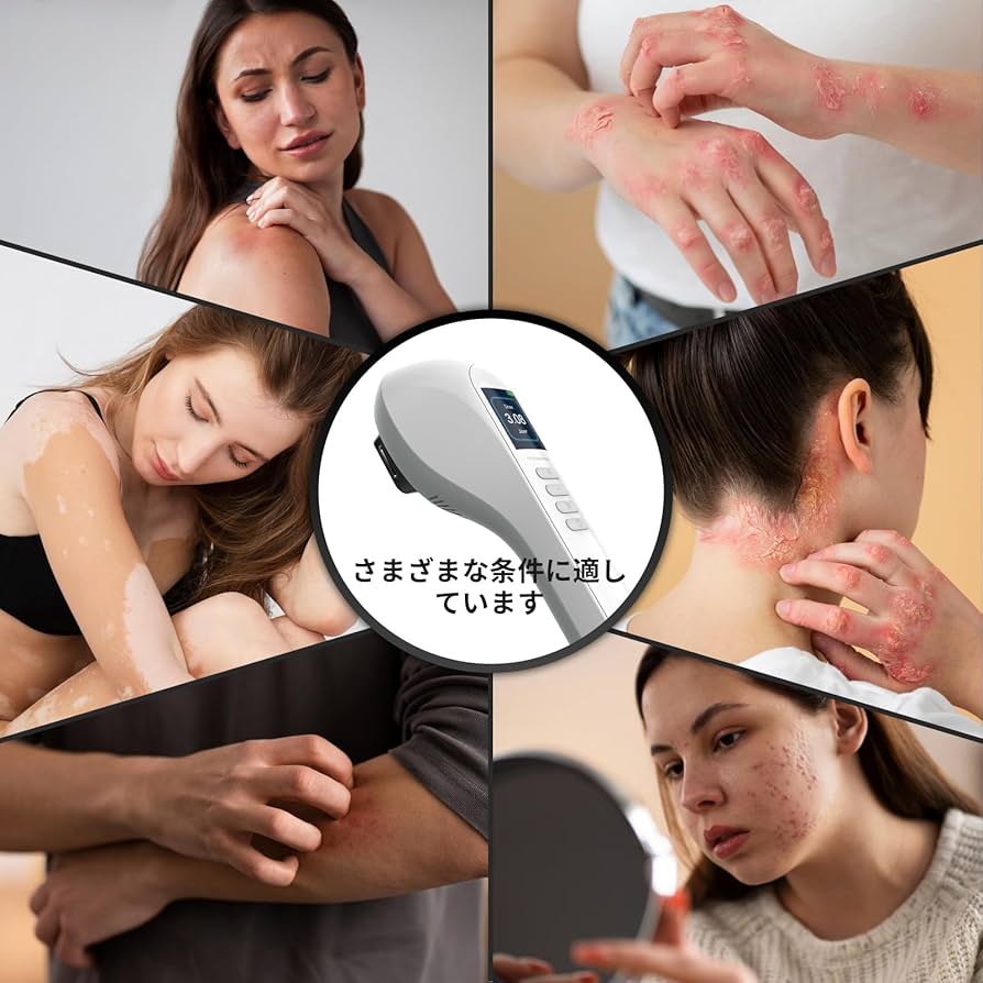 Amazon | エキシマライト光線 308エキシマーシステム 家庭用エキシマー