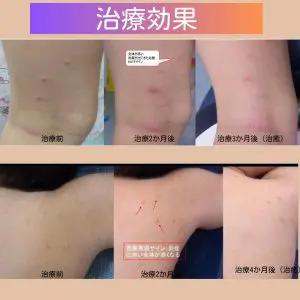 水いぼクリーム | 西宮市の皮膚科|なないろ皮ふ科西宮