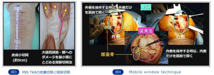 膝関節外科グループ | 診療内容 | 整形外科 | 大阪医療センター