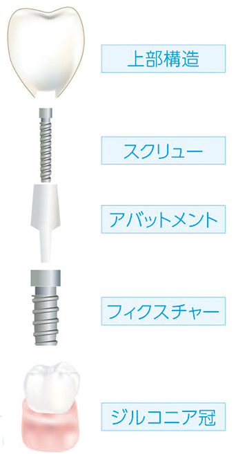インプラント料金