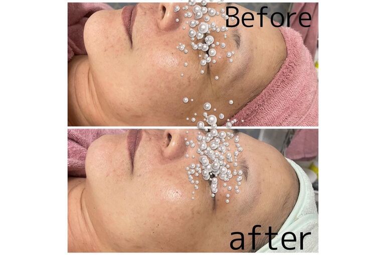 酵素100％の力でピーリング効果UP『REVI陶肌トリートメント