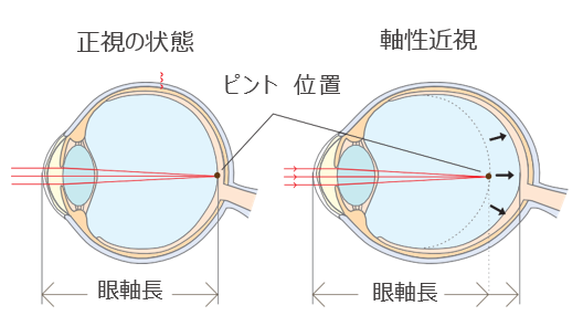 近視進行抑制治療（低濃度アトロピン点眼・EDOF・レッドライト療法