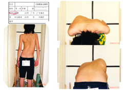 側湾症 【大塚整体治療院】 そくわん症 側わん症 側弯症