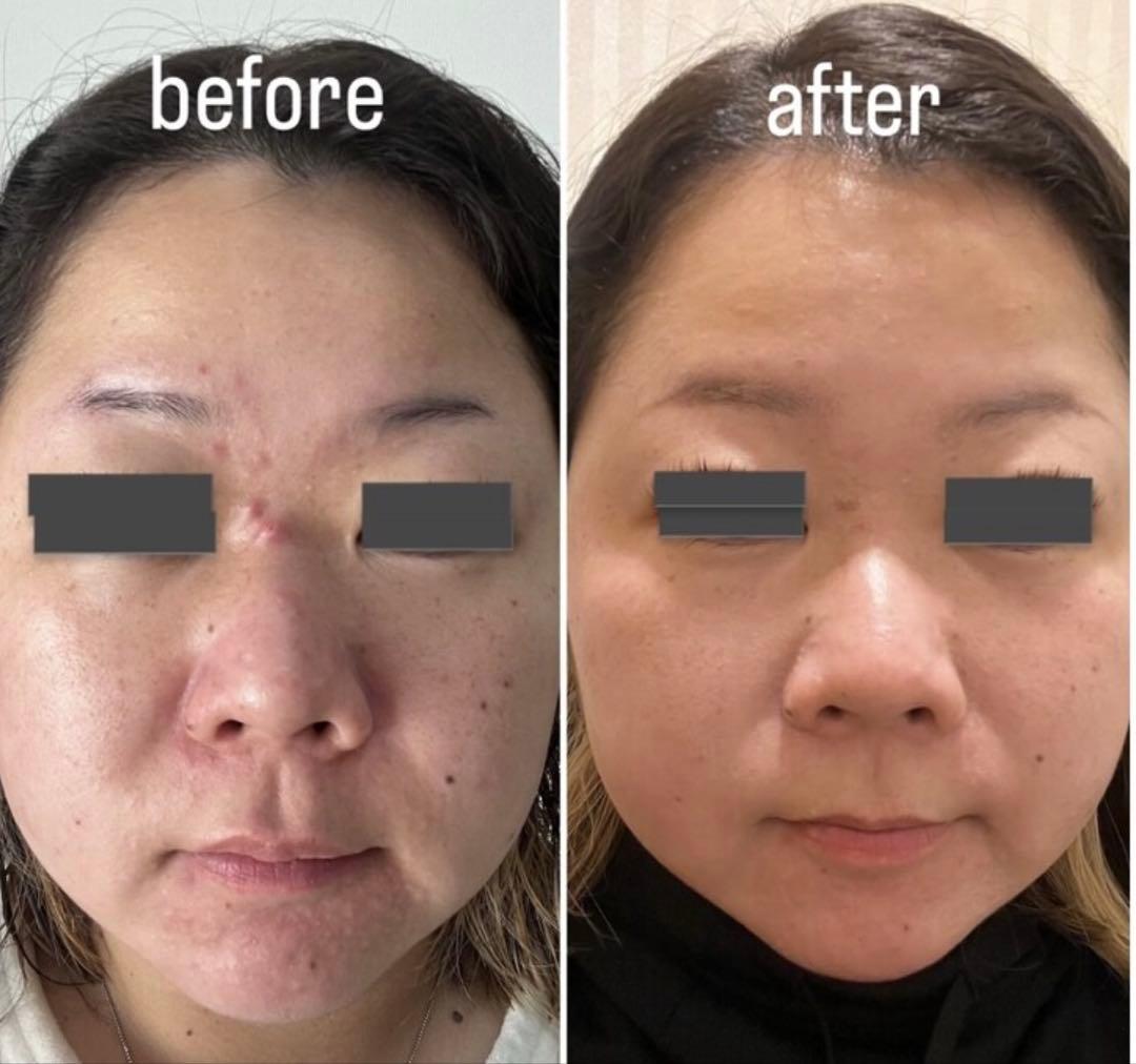 ハーブピーリング 剥離あり 7回分→7g