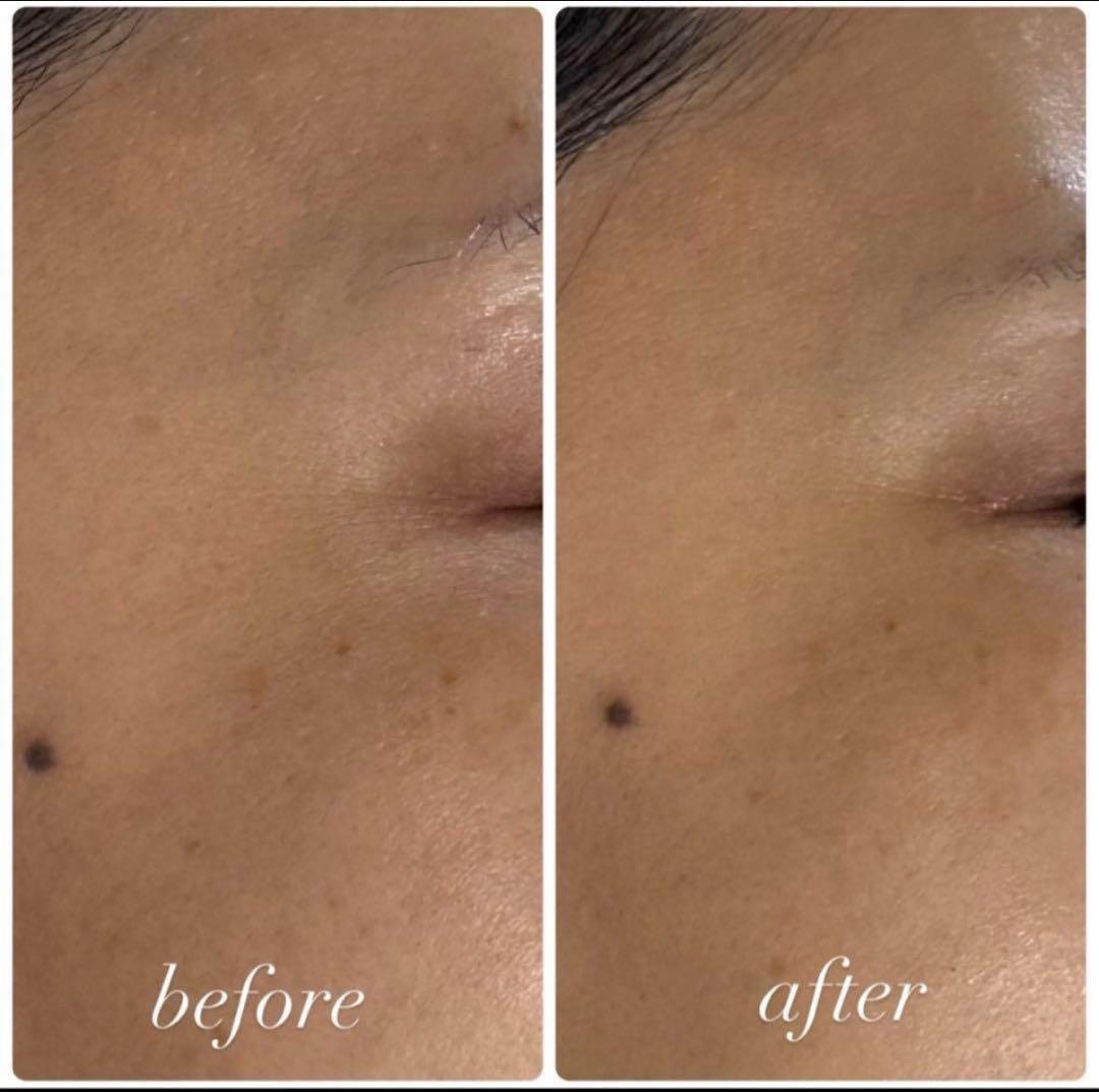 サロン専売品☆ハーブピーリング ダウンタイムなし！剥離なし！肌質改善 小分け販売