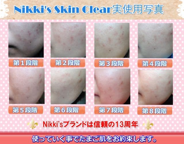 ニキビ跡、毛穴、しみ、そばかす 噂のNikki's Skin Clear 通常版