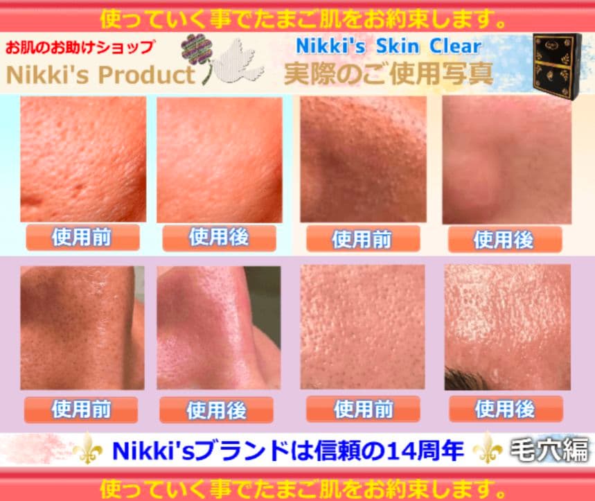 ニキビ跡、毛穴、しみ、そばかす 噂のNikki's Skin Clear 通常版